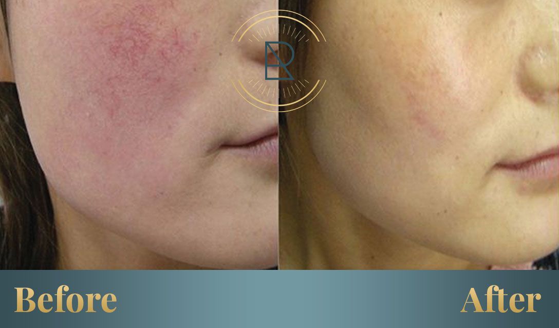 Sun Damage in Suwanee can be healed with DYE-VL at Reve Med Spa