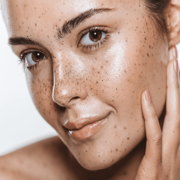 Hyperpigmentation Treatment with a Laser